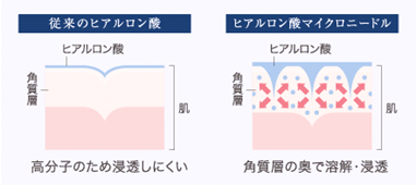 図：従来のヒアルロン酸とヒアルロン酸マイクロニードルの比較