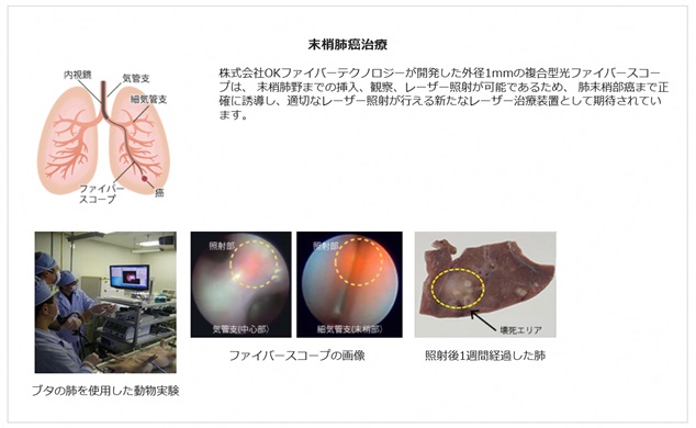 血管壁切断